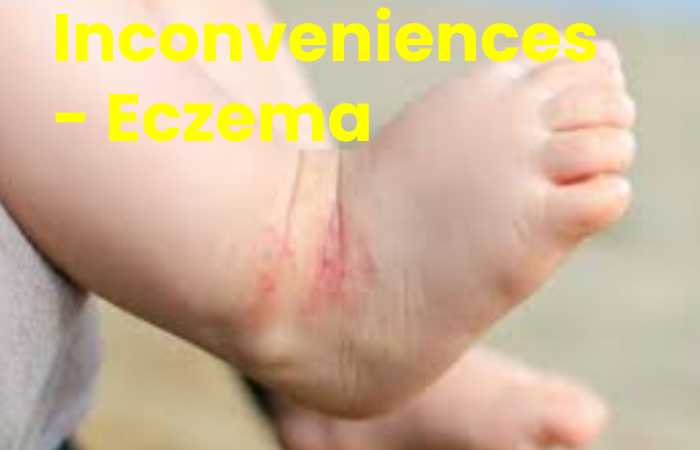Inconveniences - Eczema