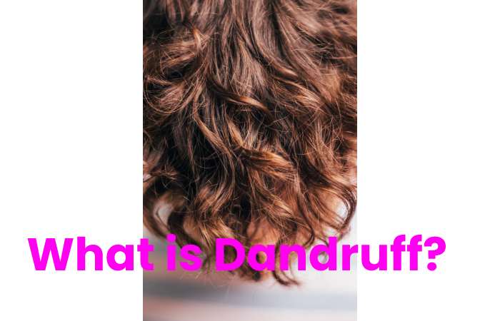What is Dandruff?