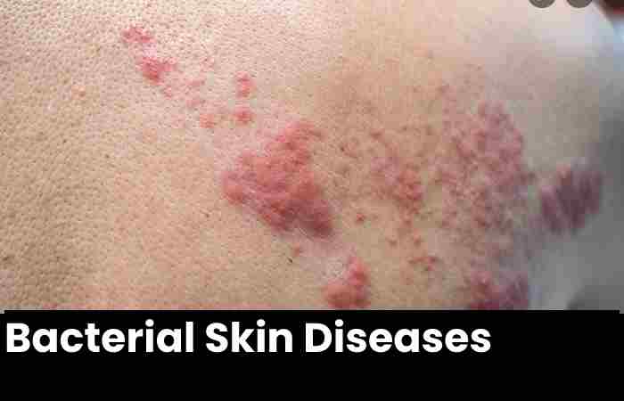 Bacterial Skin Diseases