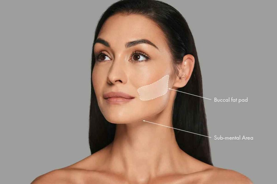 Buccal Fat