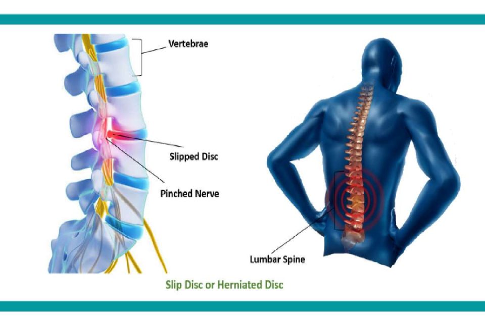 Slip Disc Symptoms
