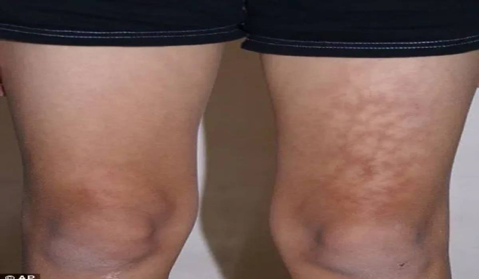 Toasted Skin Disorder