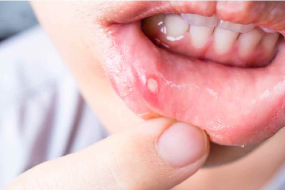 Ulcer