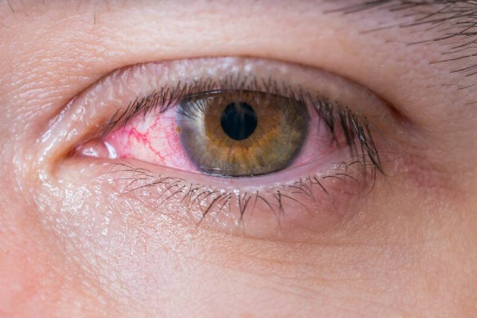 uveitis