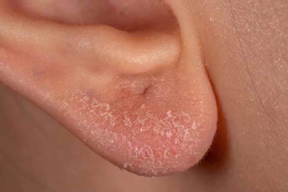 Dry Skin in Ear