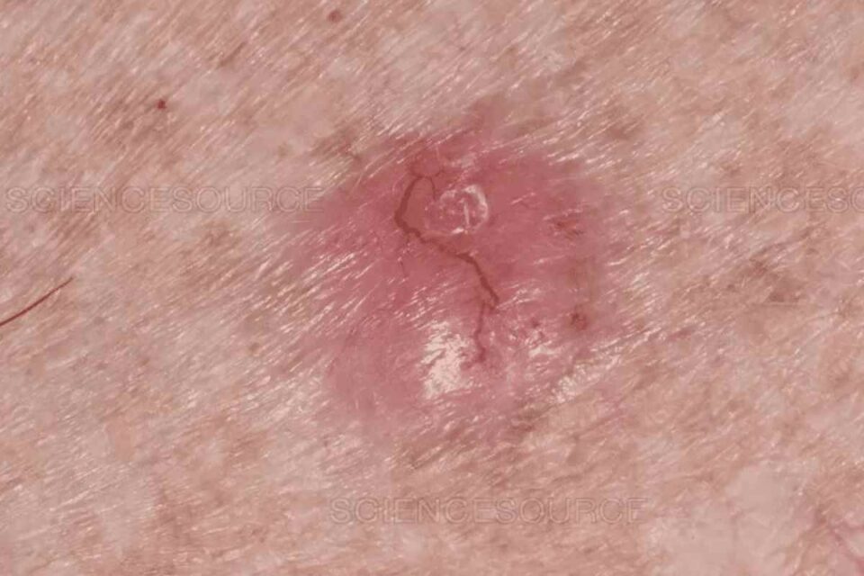 Skin Cancer