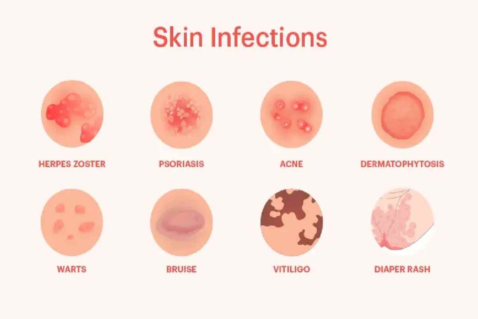 Skin Infections