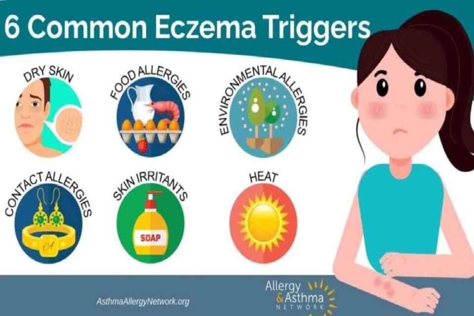 eczema