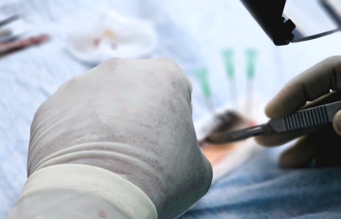 Close-up of a surgical procedure focusing on hair transplant with precision tools.