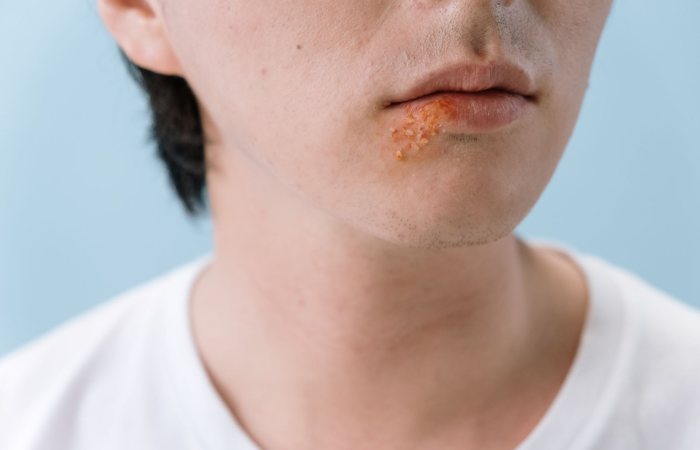 A close-up image of a person's lips showing a cold sore on the lower lip area.