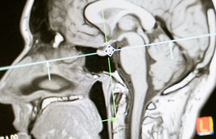 Close-up of an MRI scan showing a sagittal view of the human brain for analysis.