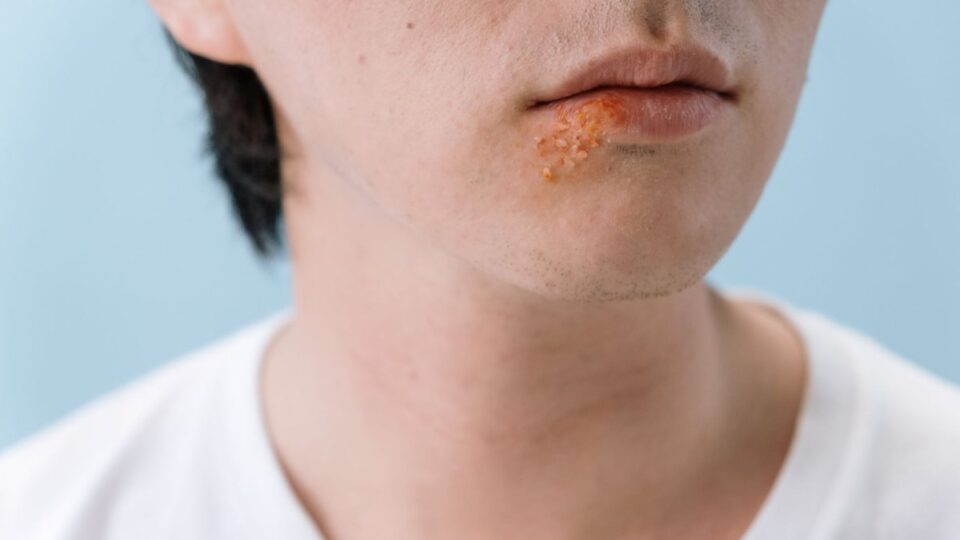 herpes photos in different stages
